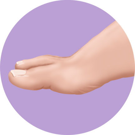 Bunion Foot Procedure Chevron Step 1