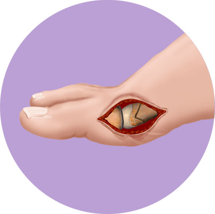 Bunion Foot Procedure Chevron Step 2