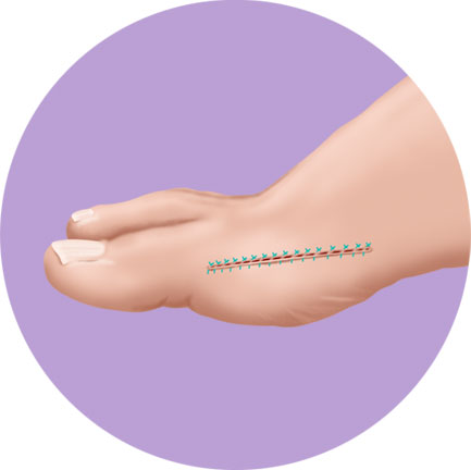 Bunion Foot Procedure Chevron Step 3