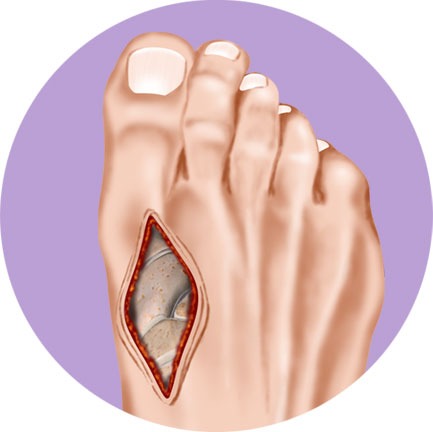 Bunion Foot Procedure Lapidus Step 2