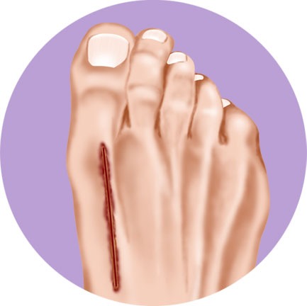 Bunion Foot Procedure Lapidus Step 3