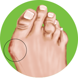 bunion-spotlight What are bunions?