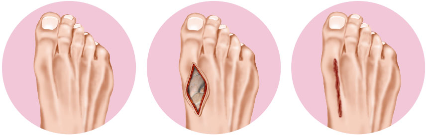 Lapidus Procedure with Staple Compression Plates Lapidus Procedure with Staple Compression Plates