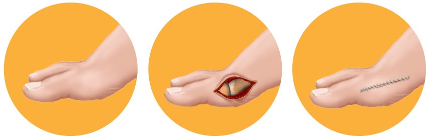 Severe Bunion Open Bunion Procedure Severe Bunion Open Bunion Procedure