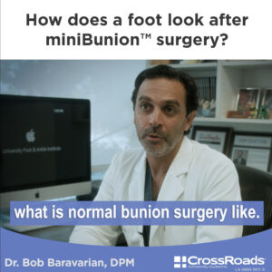 How does a foot look after miniBunion surgery?