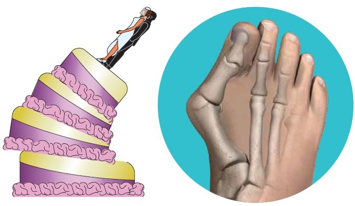 Bunion-Compared-To-Wedding-Cake