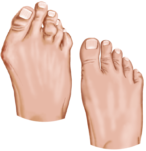 bunion-foot-side-by-side