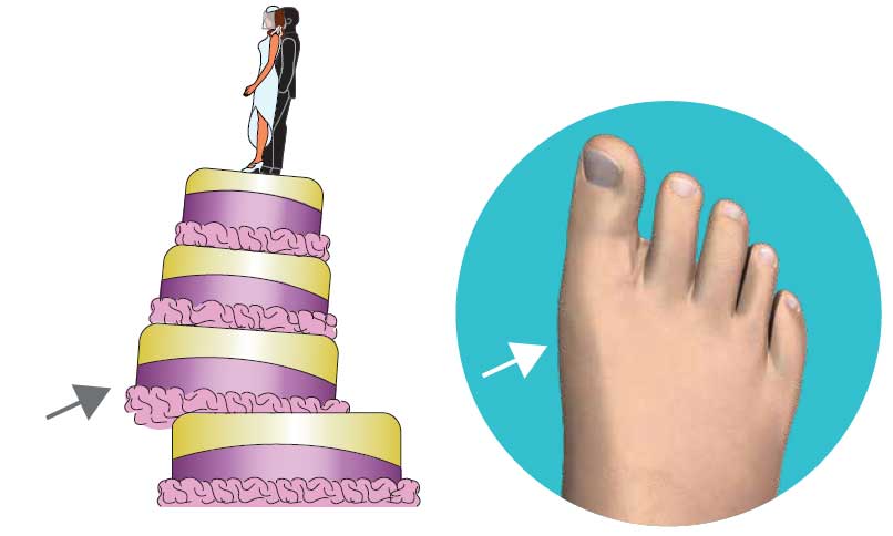 First Dimension Bunion Surgery After First Dimension Bunion Surgery After
