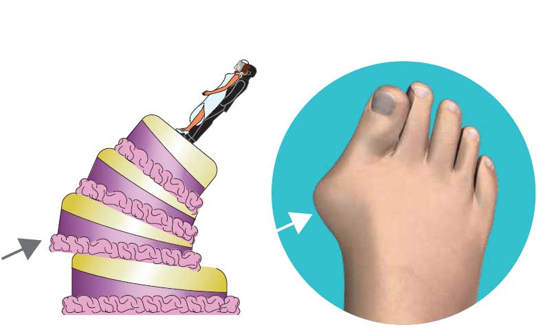 first-dimension-before Minimal Incision Bunion Correction