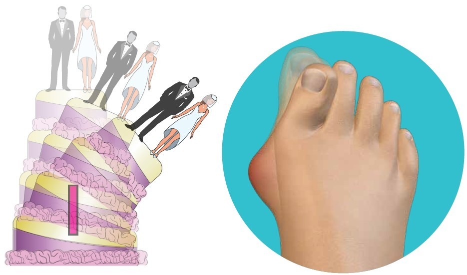 Fourth Dimension Bunion Surgery Composite Fourth Dimension Bunion Surgery Composite