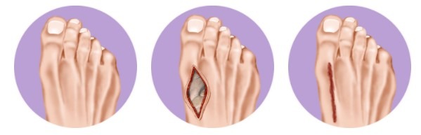 Lapidus Bunion Surgery Illustration