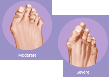 Moderate & Severe Bunion Illustrations Moderate & Severe Bunion Illustrations