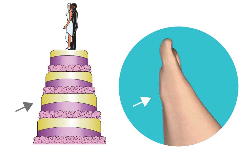 Second Dimension Bunion Surgery After Second Dimension Bunion Surgery After