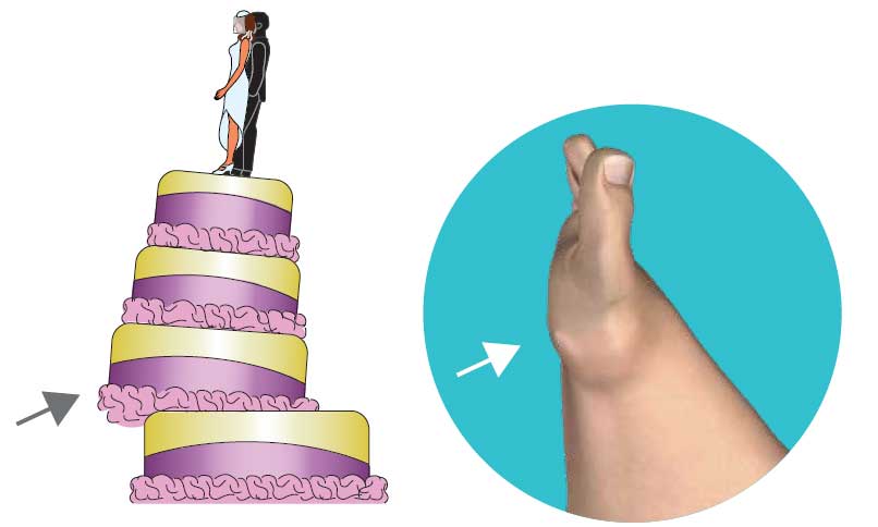 Second Dimension Bunion Surgery Before Second Dimension Bunion Surgery Before