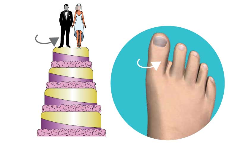 Third Dimension Bunion Surgery After Third Dimension Bunion Surgery After