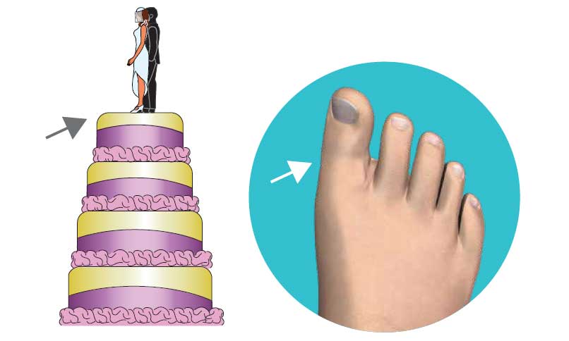 Third Dimension Bunion Surgery Before Third Dimension Bunion Surgery Before