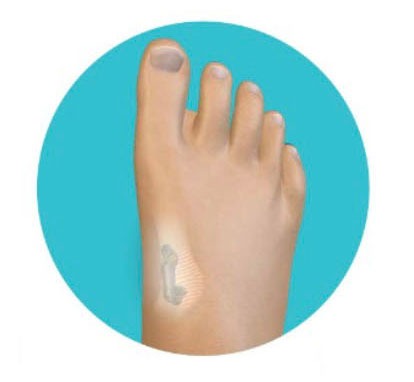 dynabunion-compression-medical-device