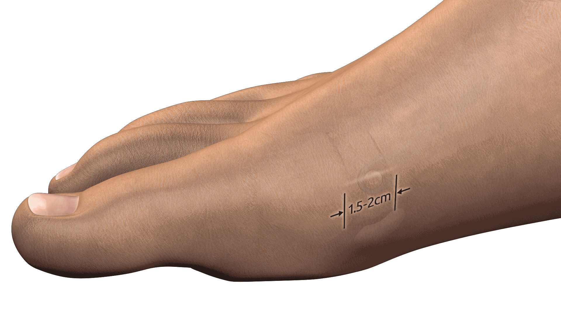MINIBunion Minimally-Invasive Magic! MINIBunion Minimally-Invasive Magic!