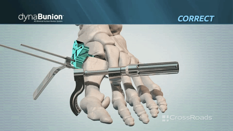 The dynaBunion™ instruments act like an extra set of hands to drastically reduce the frustration of maintaining 4D alignment The dynaBunion™ instruments act like an extra set of hands to drastically reduce the frustration of maintaining 4D alignment