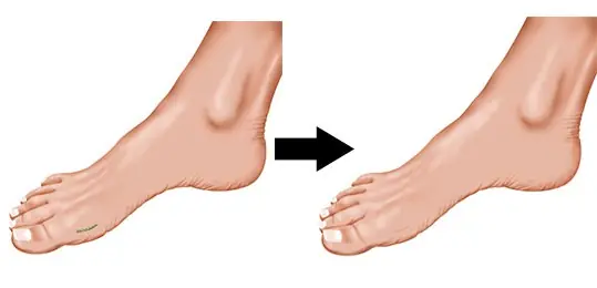 MiniBunion Procedure Scarring MiniBunion Procedure Scarring
