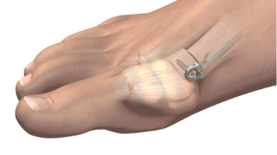 MiniBunion Preserves the Joint Capsule MiniBunion Preserves the Joint Capsule