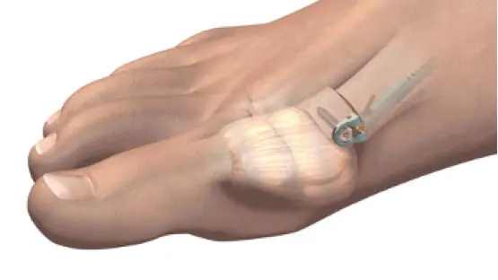MiniBunion Preserves the Joint Capsule MiniBunion Preserves the Joint Capsule
