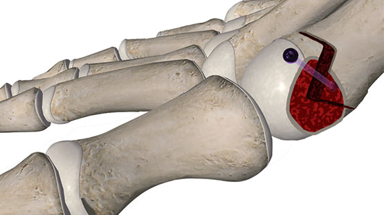 Traditional Bunion Procedure Traditional Bunion Procedure