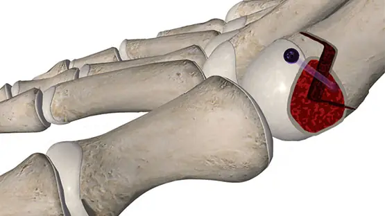 Traditional Bunion Procedure Traditional Bunion Procedure